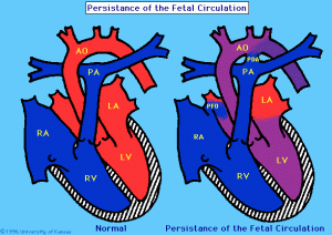http://trialx.com/curebyte/2011/07/13/clinical-trials-and-related-photos-for-persistent-pulmonary-hypertension-newborn/